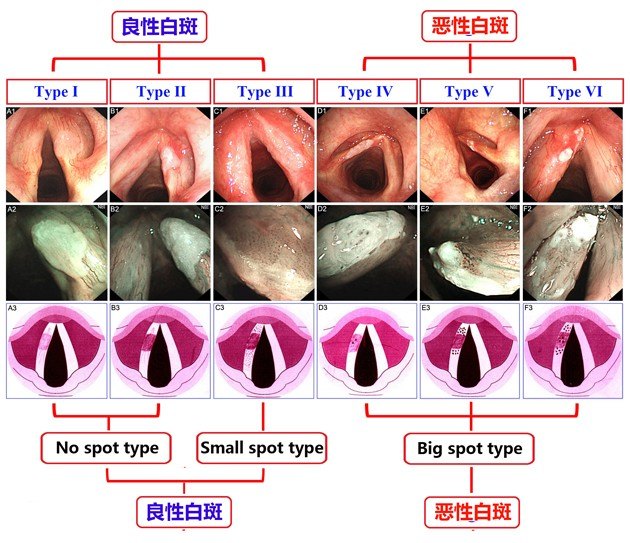 声带白斑患者需忌口的食物一览表