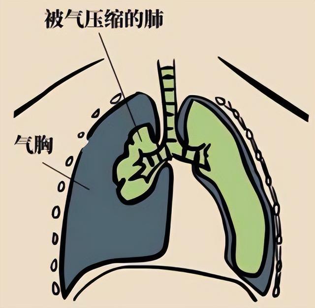 警惕气胸，三类人群需特别关注预防措施