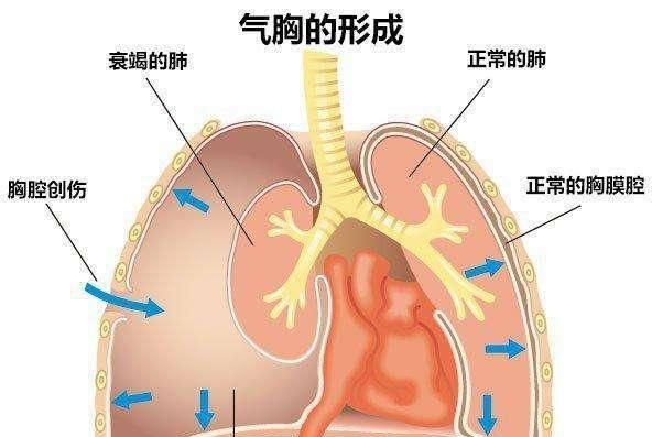 气胸深度解析，定义、成因及理解